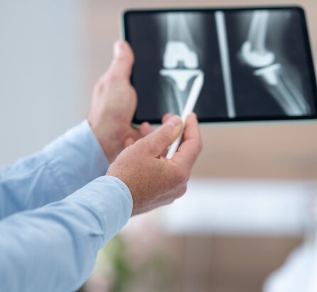 Röntgenbild von einem künstlichen Kniegelenk